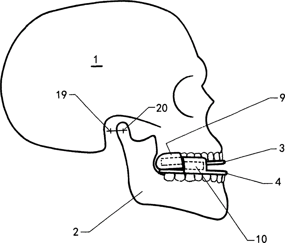 Device for the alleviation of snoring and sleep apnoea