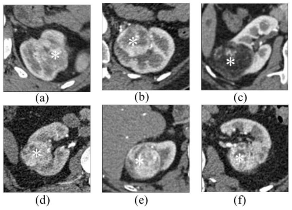 Kidney tumor segmentation method and system based on CT angiography image based on three-dimensional convolutional neural network