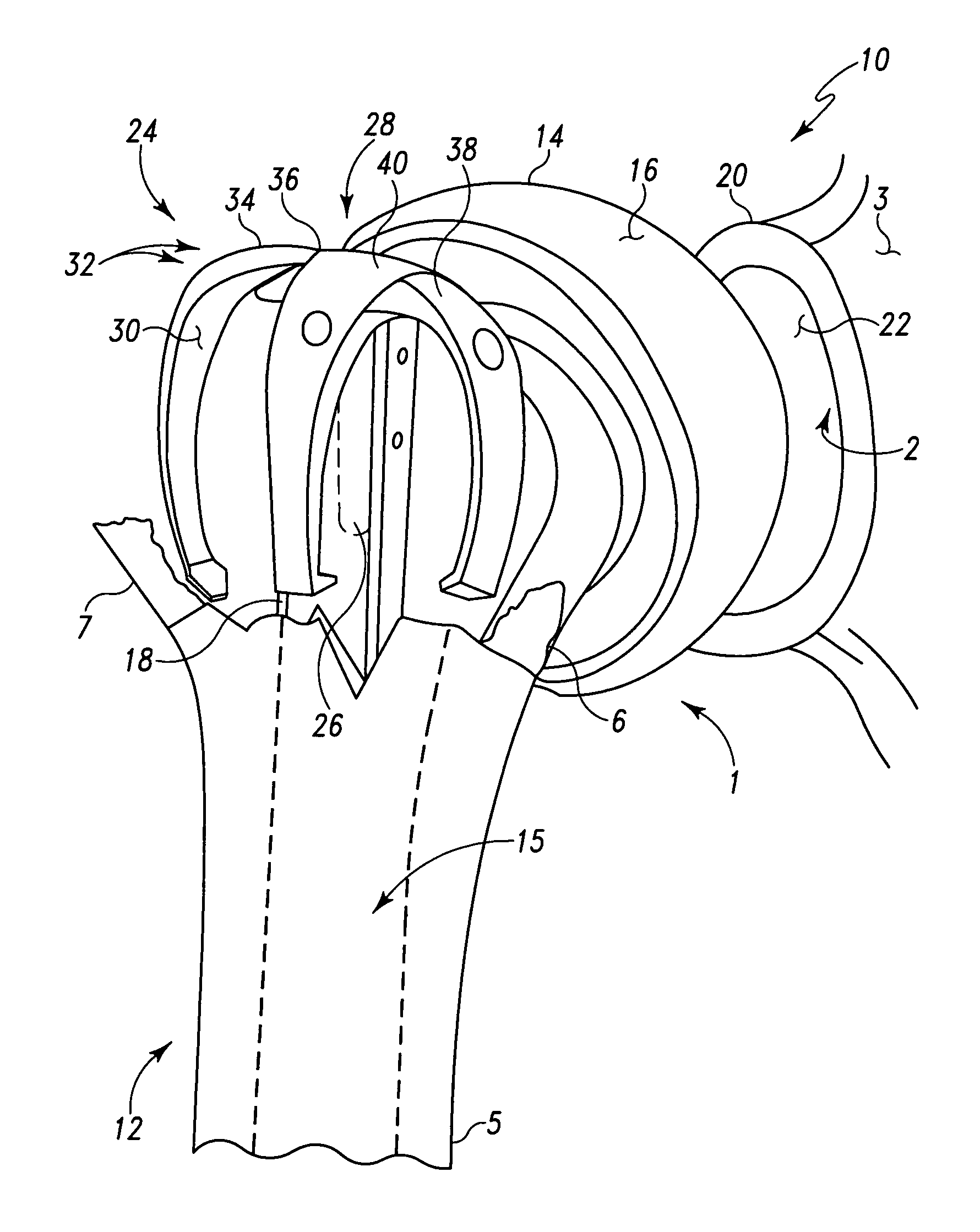 Orthopaedic stem with protrusion and associated surgical procedure