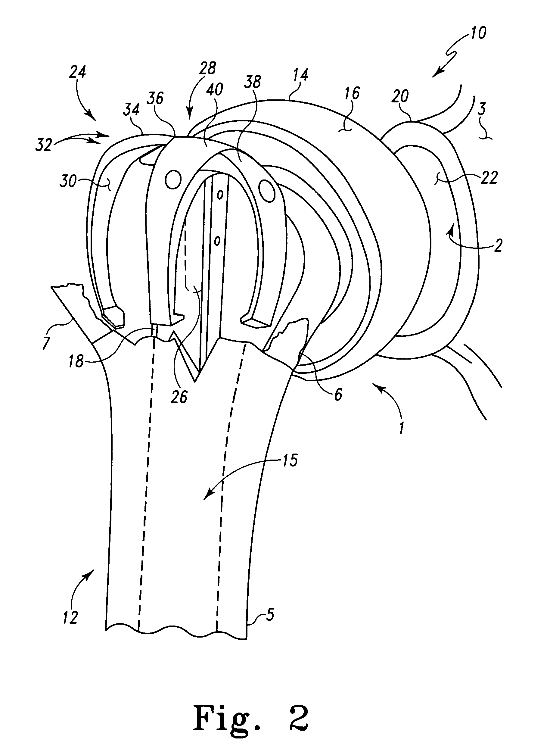 Orthopaedic stem with protrusion and associated surgical procedure