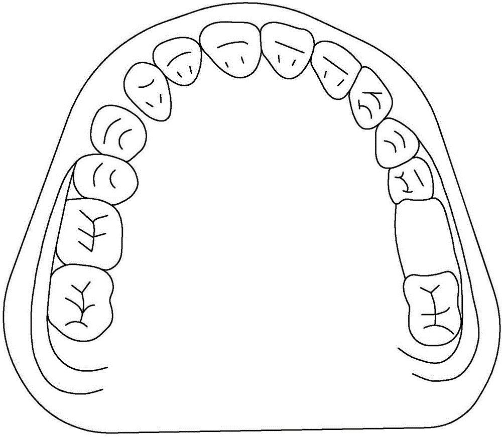 Removable denture and manufacturing process thereof