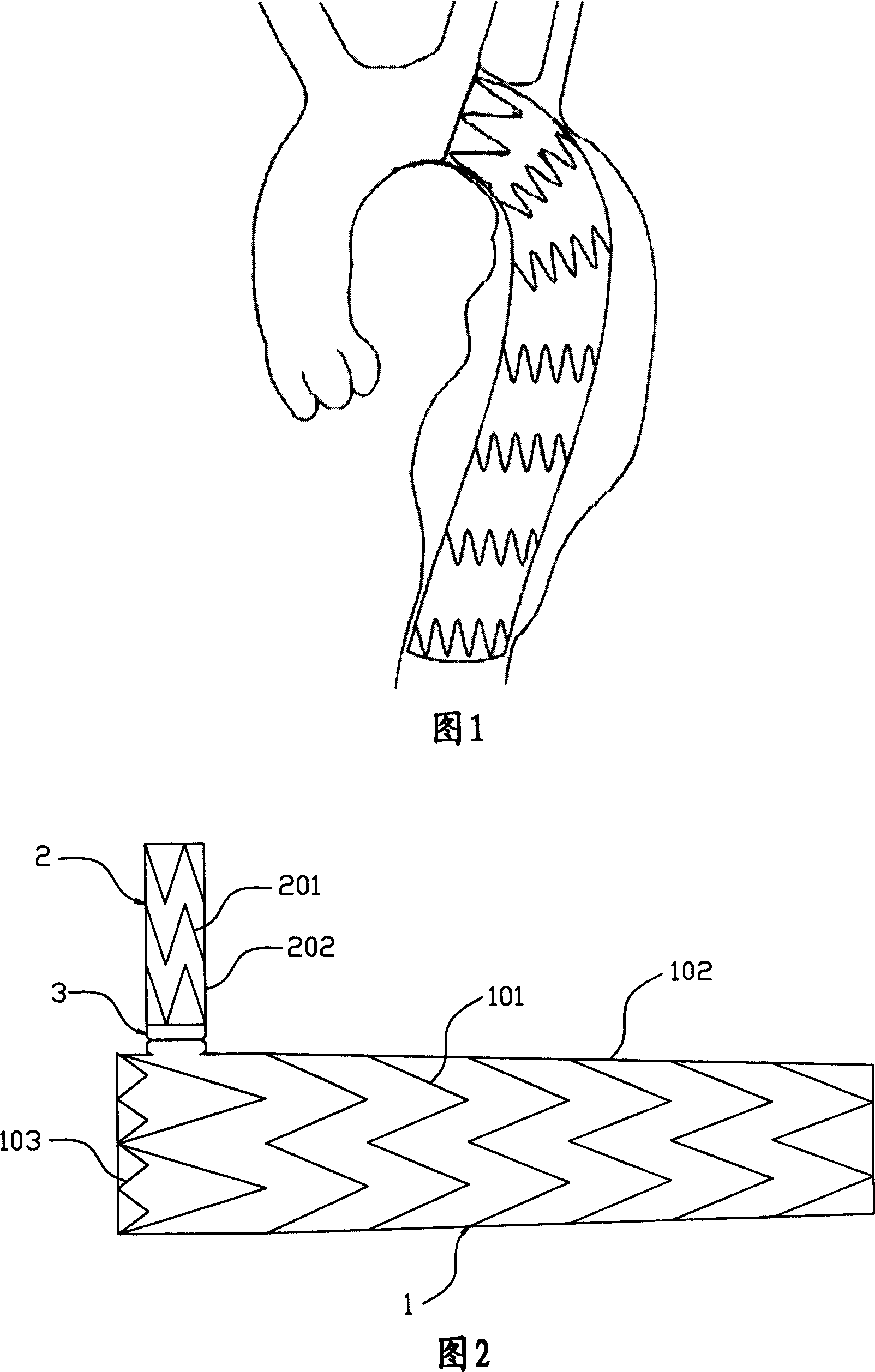 Collateral covered graft-stent and releasing method thereof