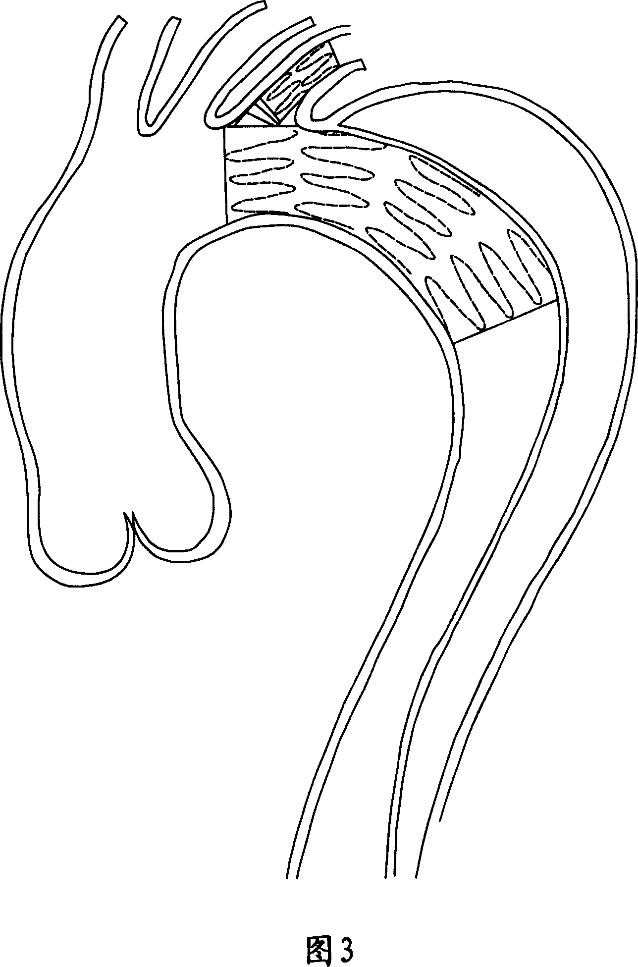 Collateral covered graft-stent and releasing method thereof