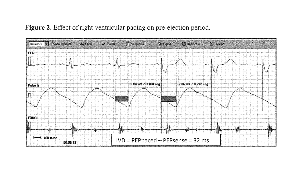 Device and method for assessment of left ventricular ejection fraction and other parameters of cardiac performance