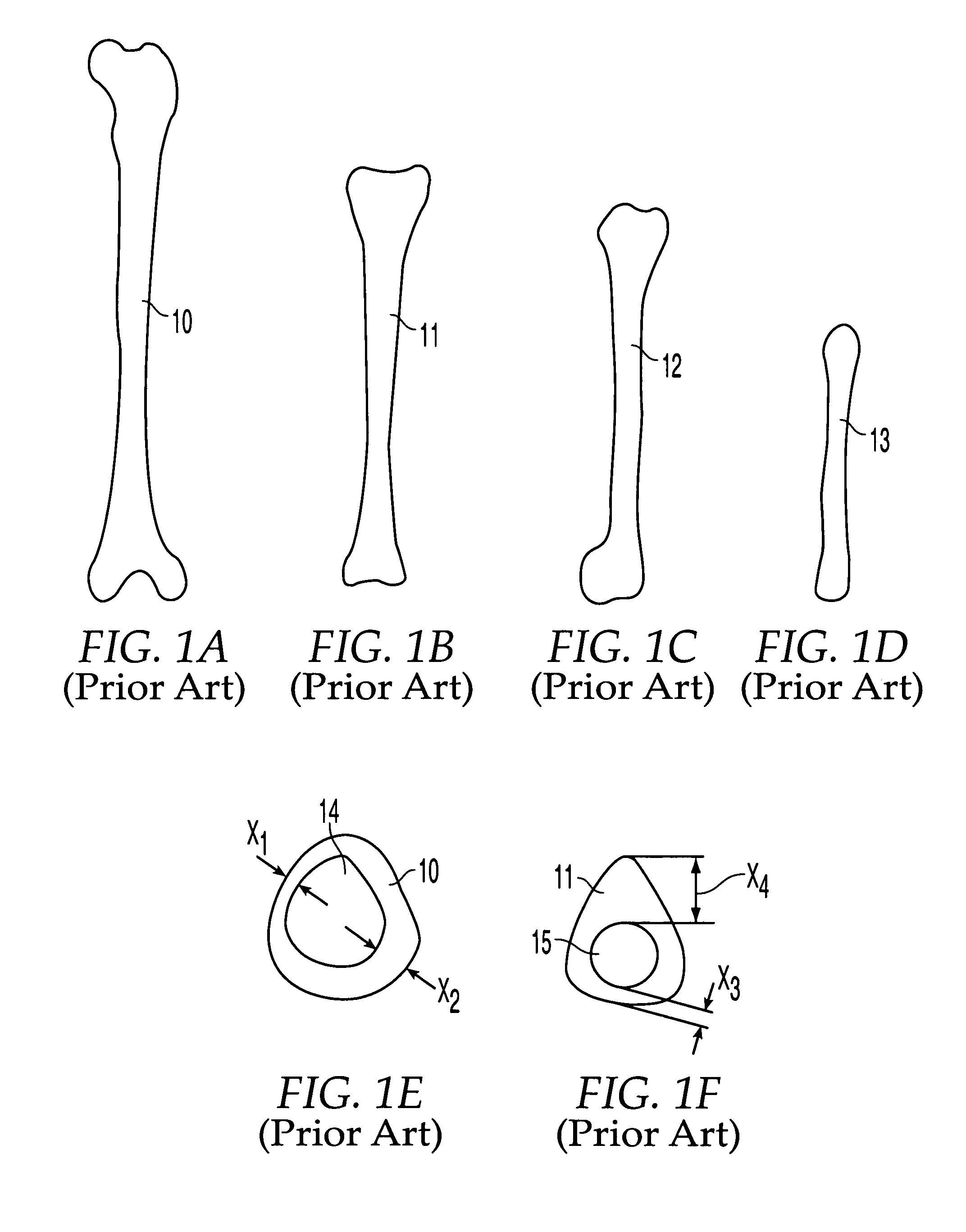 Implants formed of coupled bone