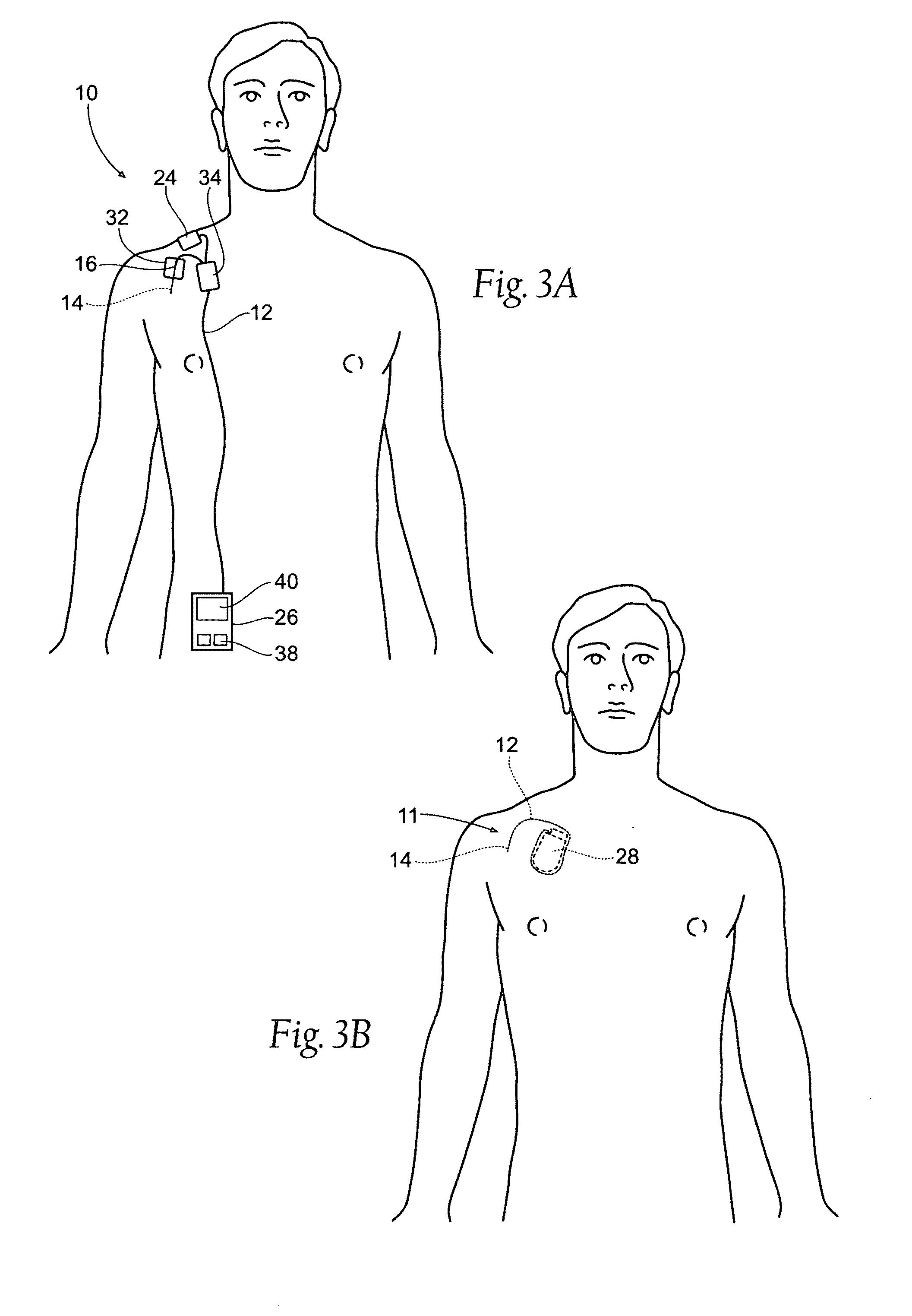 Systems and methods to place one or more leads in muscle for providing electrical stimulation to treat pain