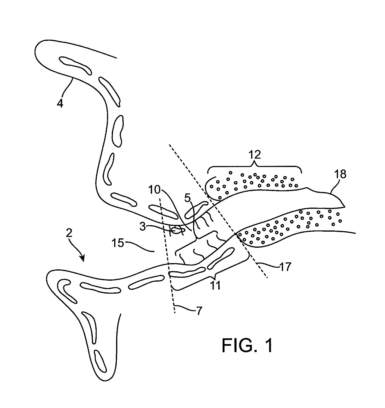 Combined microphone and receiver assembly for extended wear canal hearing devices