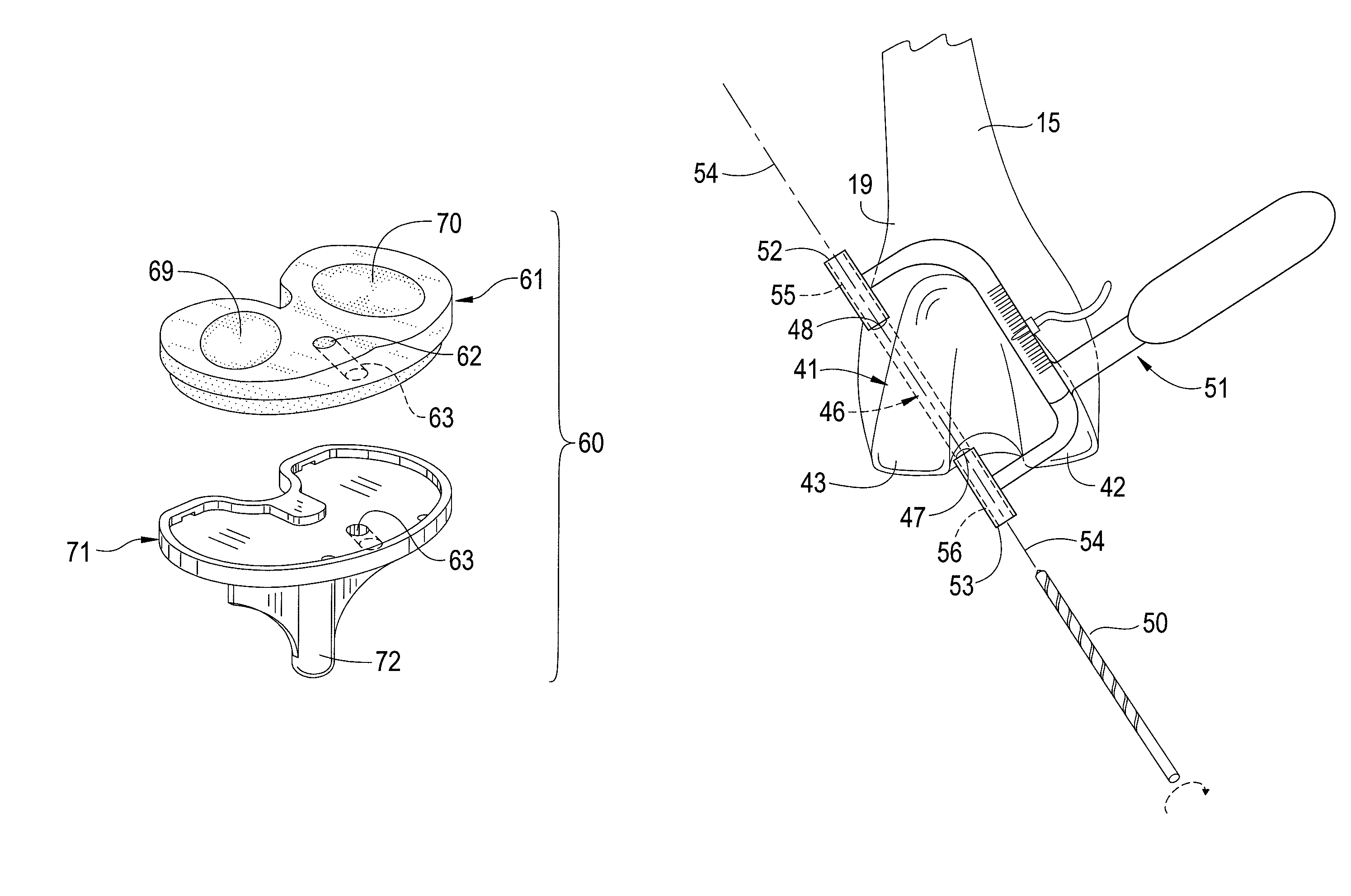Total knee prosthesis and method for total knee arthroplasty