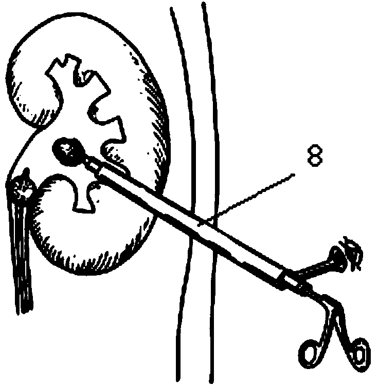 Adjustable percutaneous nephrolithotomy operation sheath