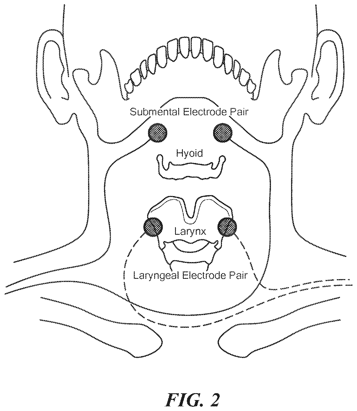 Eliciting Swallowing using Electrical Stimulation Applied via Surface Electrodes