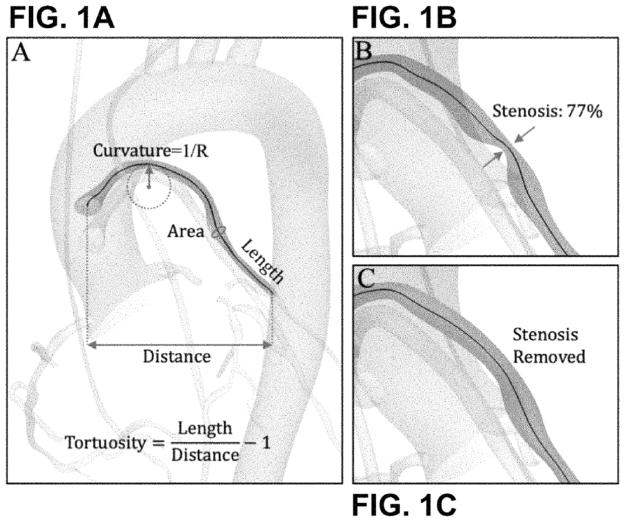 Hemodynamic and morphological predictors of vascular graft failure
