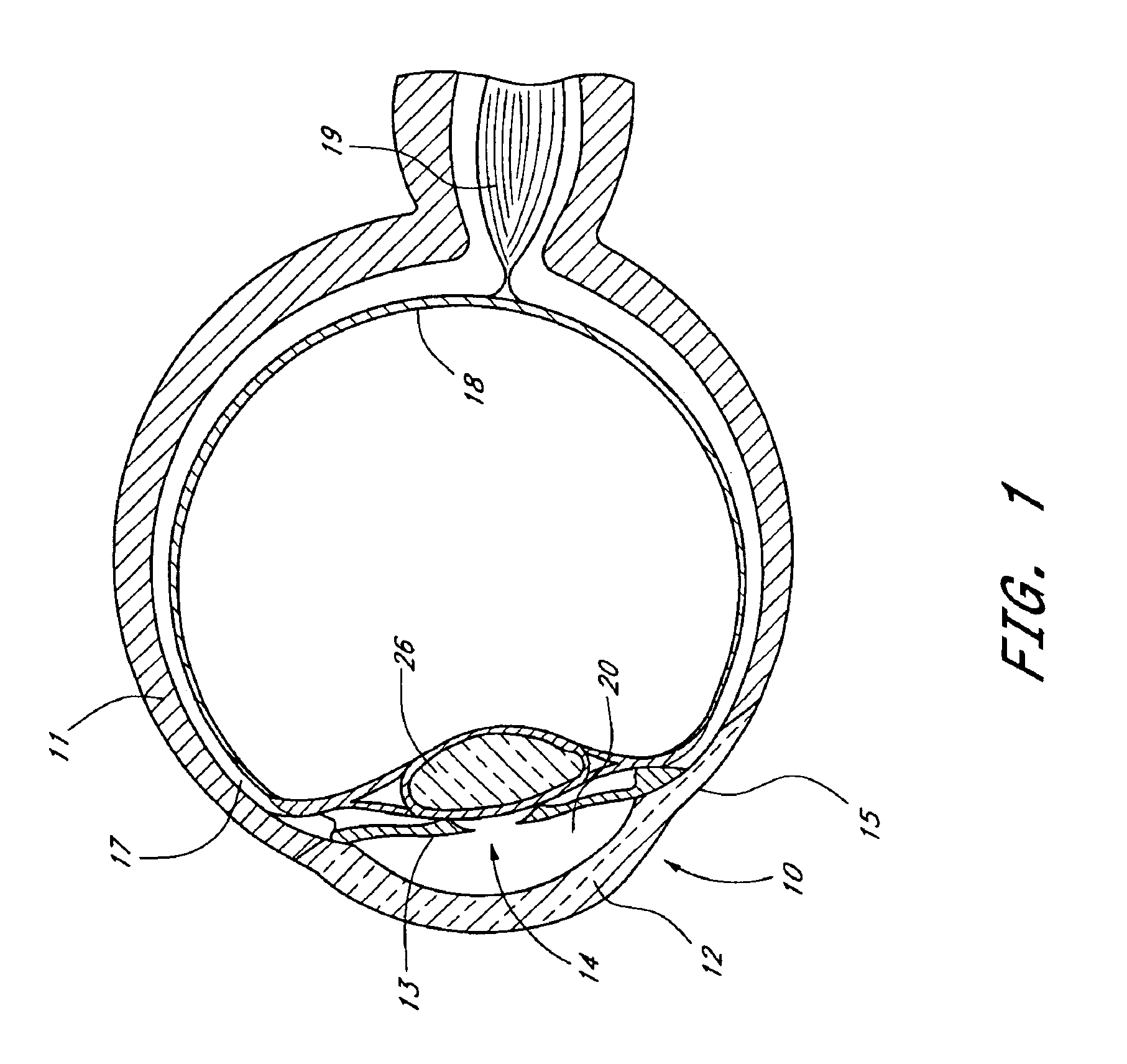 Medical device and methods of use of glaucoma treatment