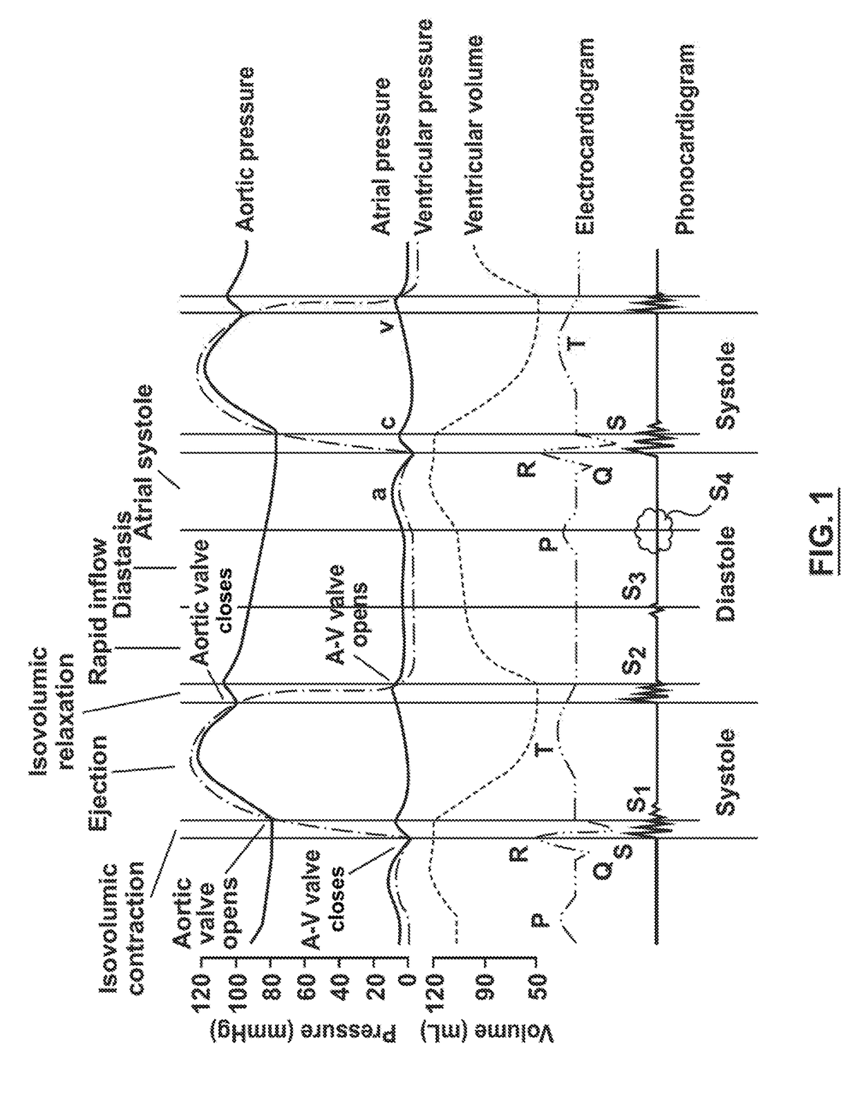 Cardiac monitor system and method for home and telemedicine application