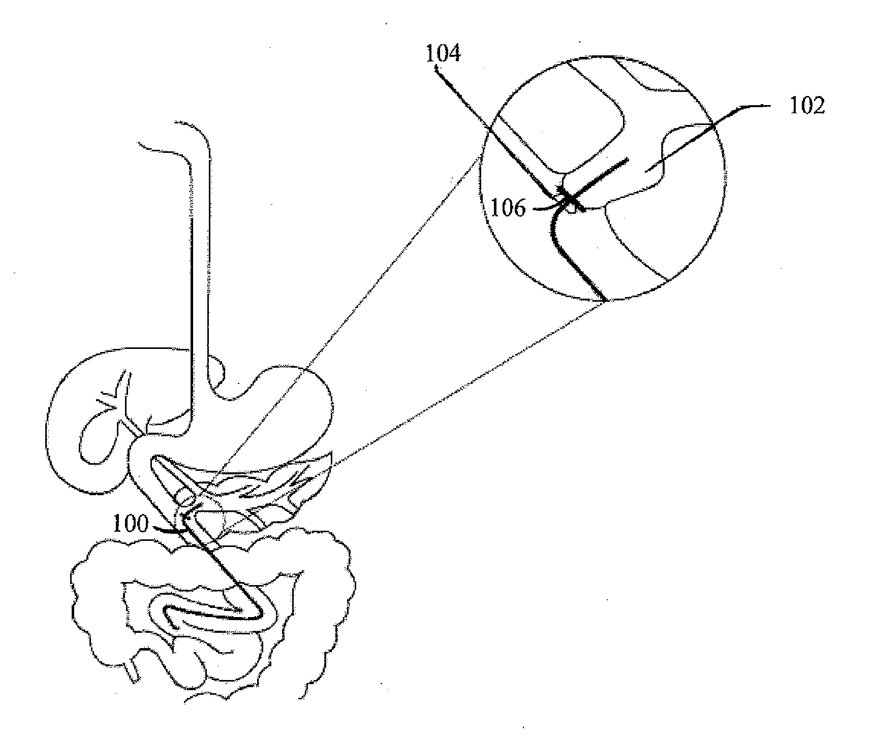 Method For Surgically Treating A Patient By Deactivating A Portion Of The Digestive Enzymes