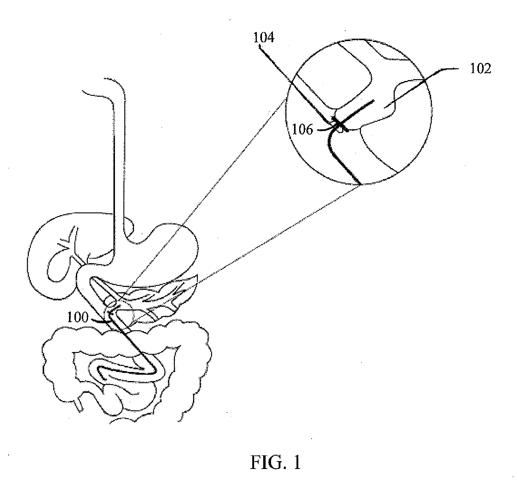 Method For Surgically Treating A Patient By Deactivating A Portion Of The Digestive Enzymes