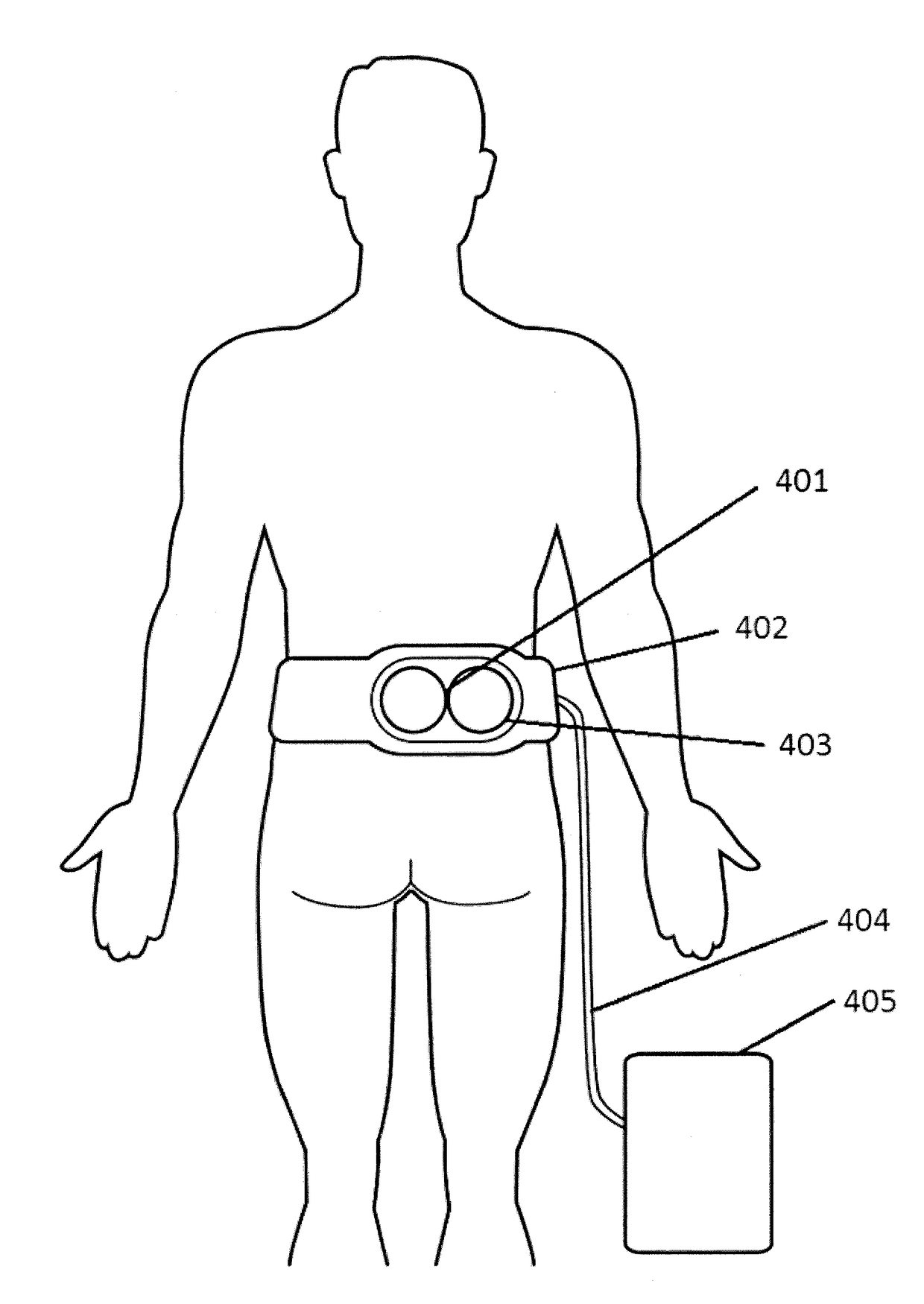 Systems and methods for spasticity treatment using spinal nerve magnetic stimulation
