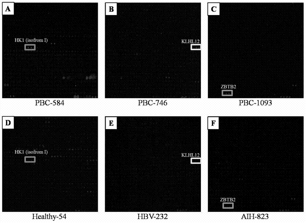 Specific autoantigen of primary biliary cirrhosis (PBC) and application thereof