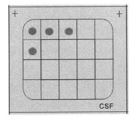 Genetic testing kit for infected bacteria in cerebrospinal fluid