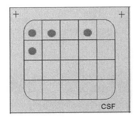 Genetic testing kit for infected bacteria in cerebrospinal fluid