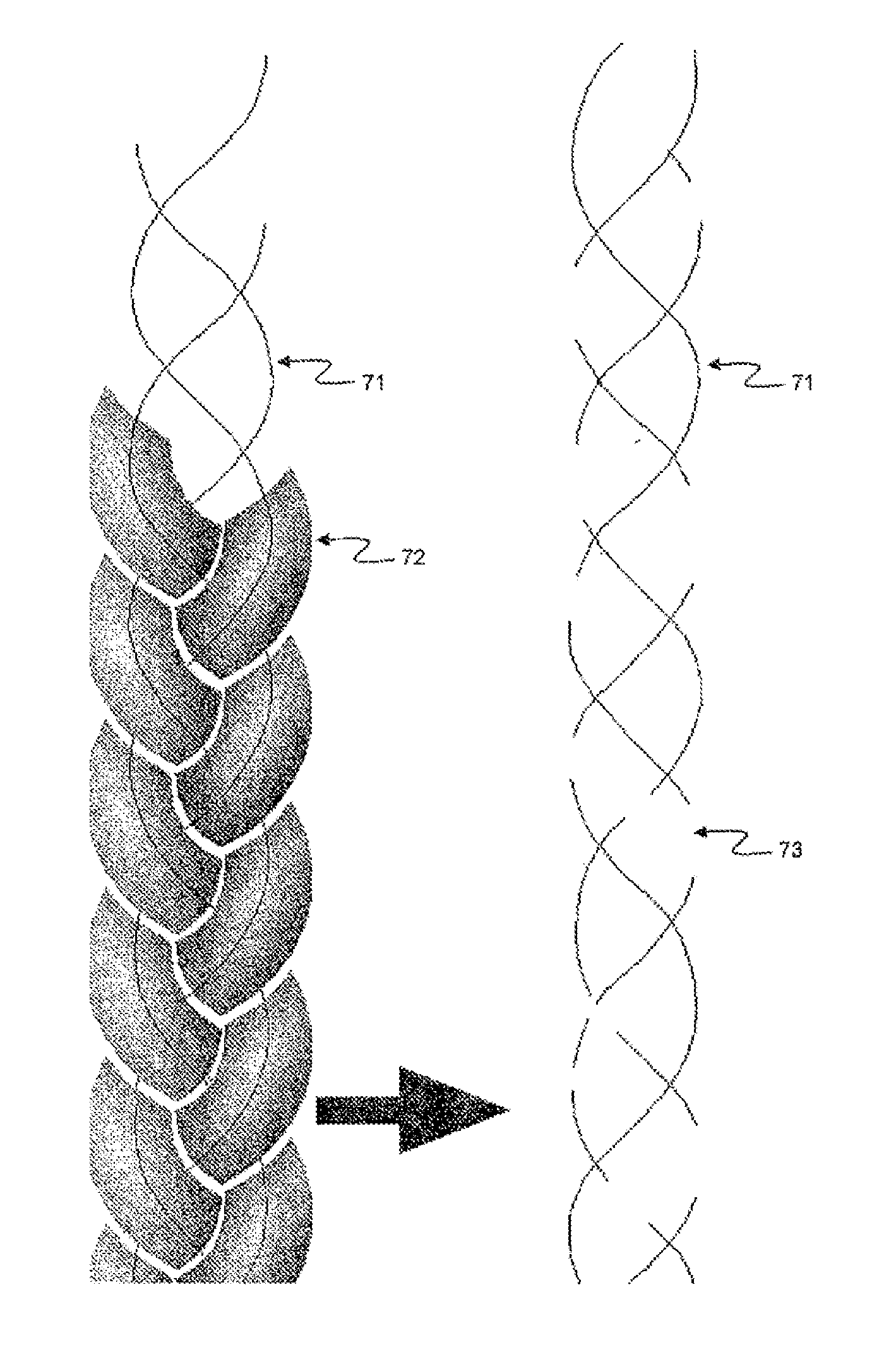 Supporting and forming transitional material for use in supporting prosthesis devices, implants and to provide structure in a human body