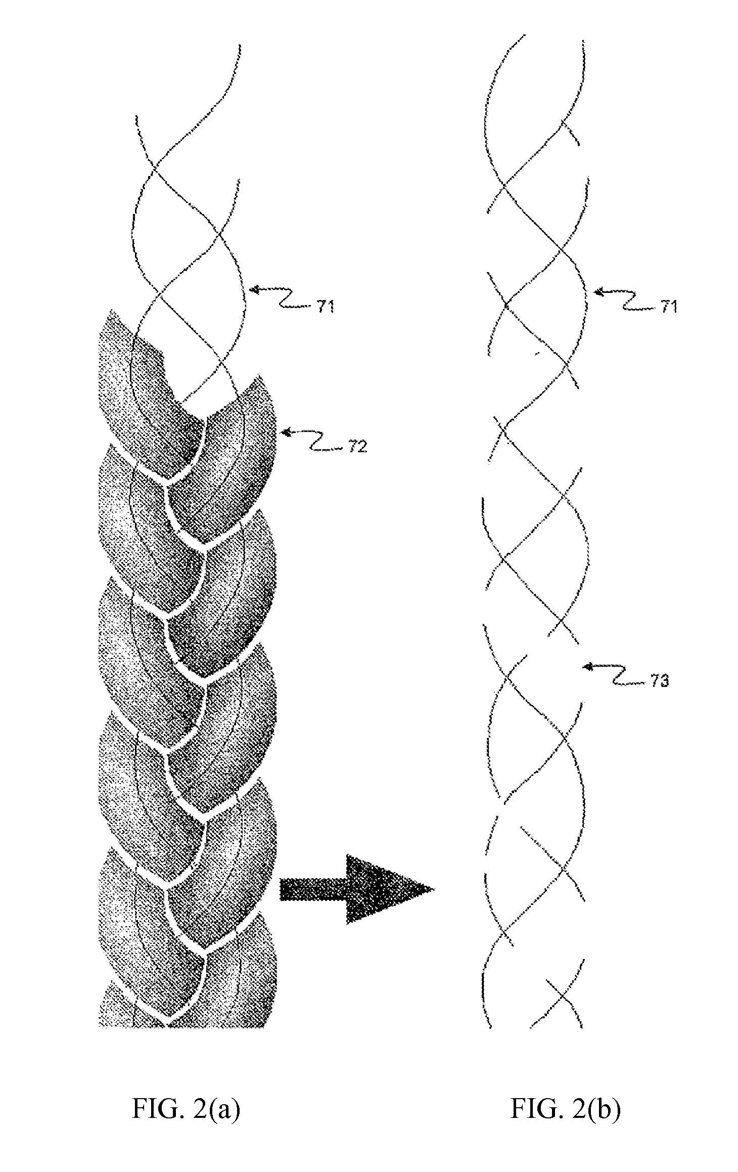 Supporting and forming transitional material for use in supporting prosthesis devices, implants and to provide structure in a human body