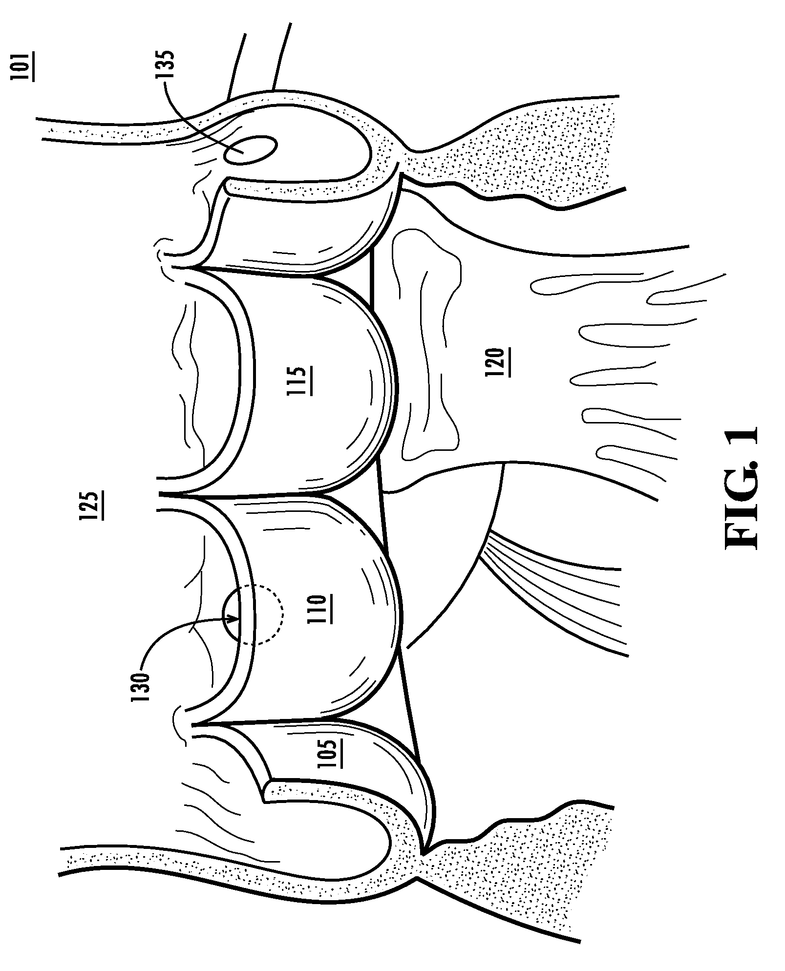 Systems and methods for enabling heart valve replacement