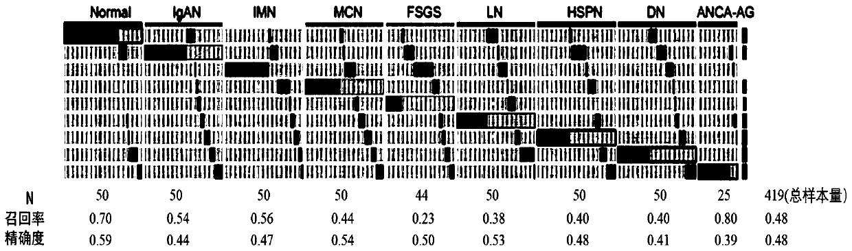 Glomerular disease classification and typing model based on immunoglobulin quantitative detection and application thereof