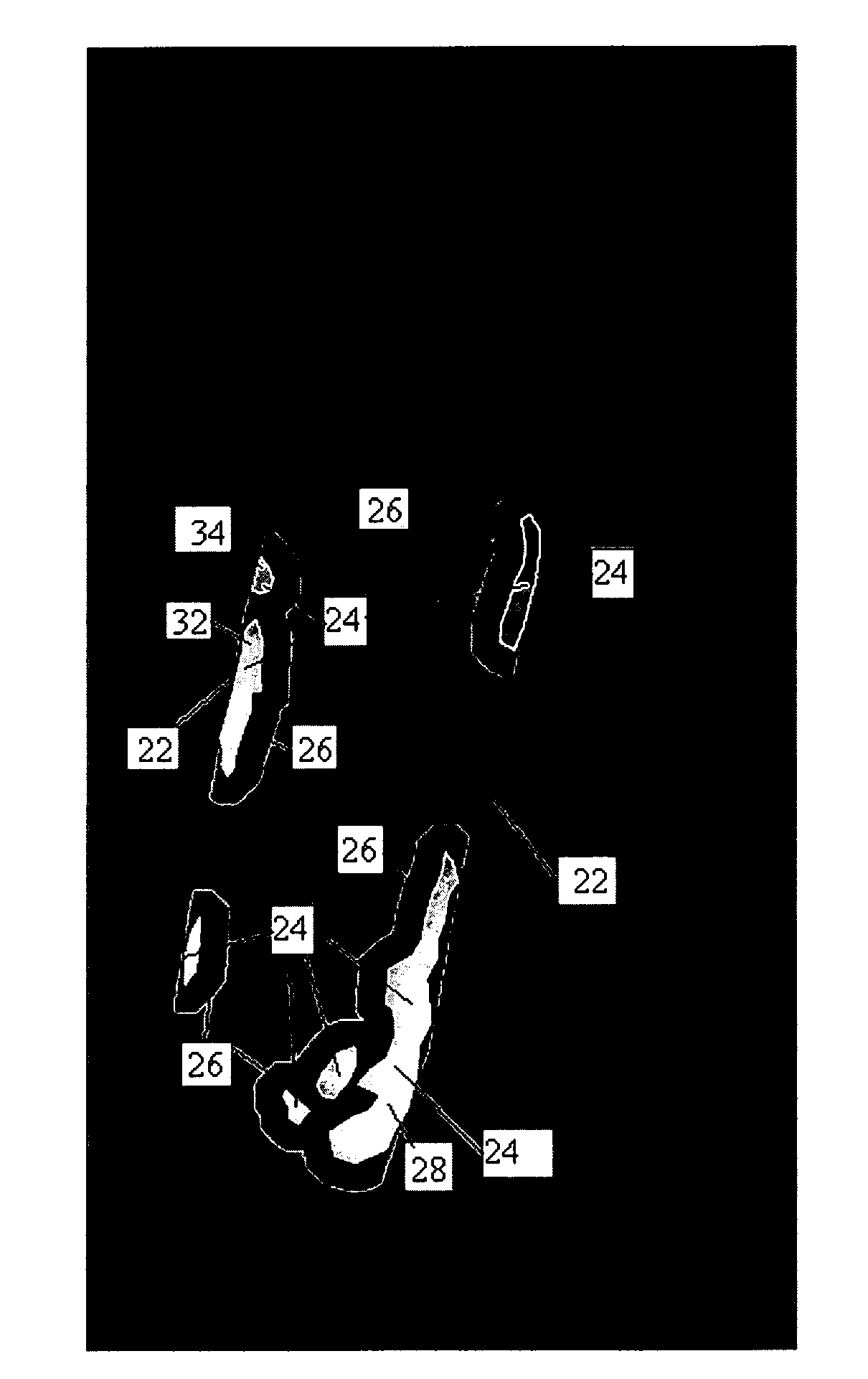 Method of deriving a quantitative measure of the instability of calcific deposits of a blood vessel