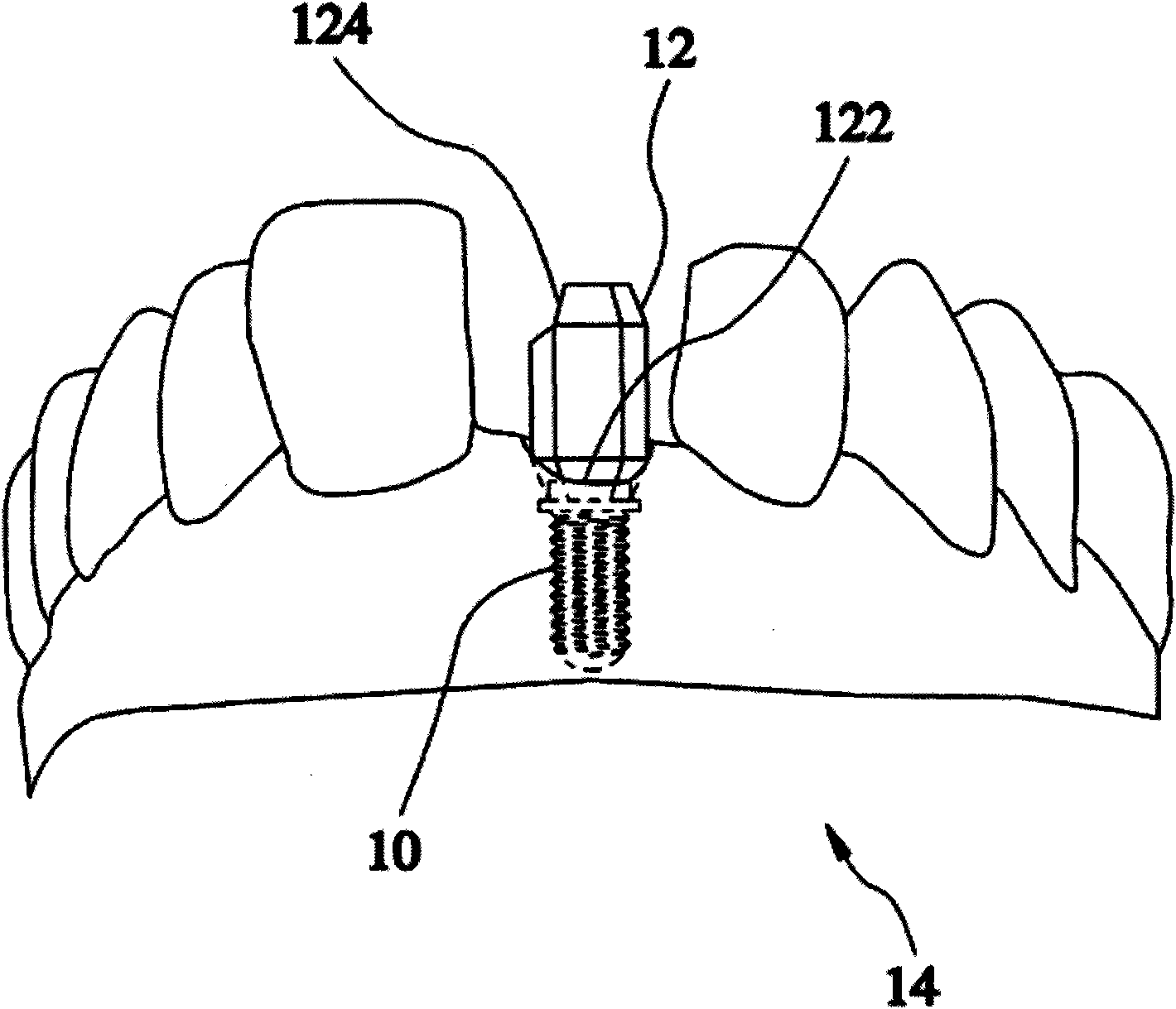 Method for producing digital model applied to dental implant and method for producing artificial teeth