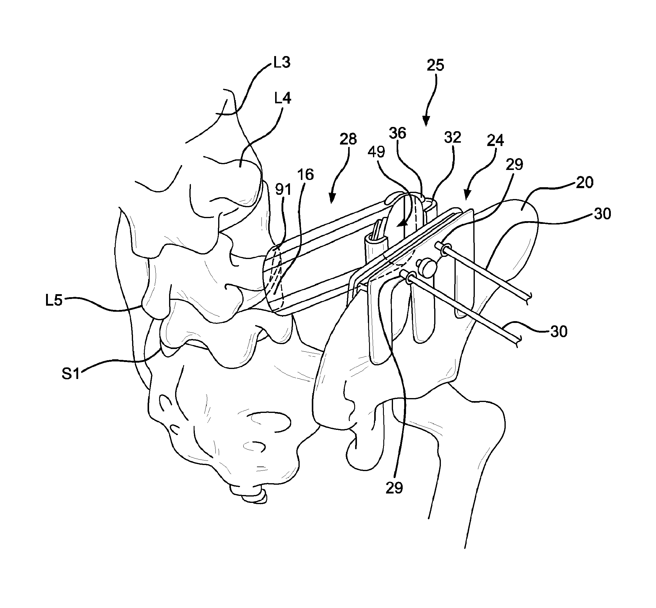 Method and apparatus for laterally accessing an intervertebral disc space