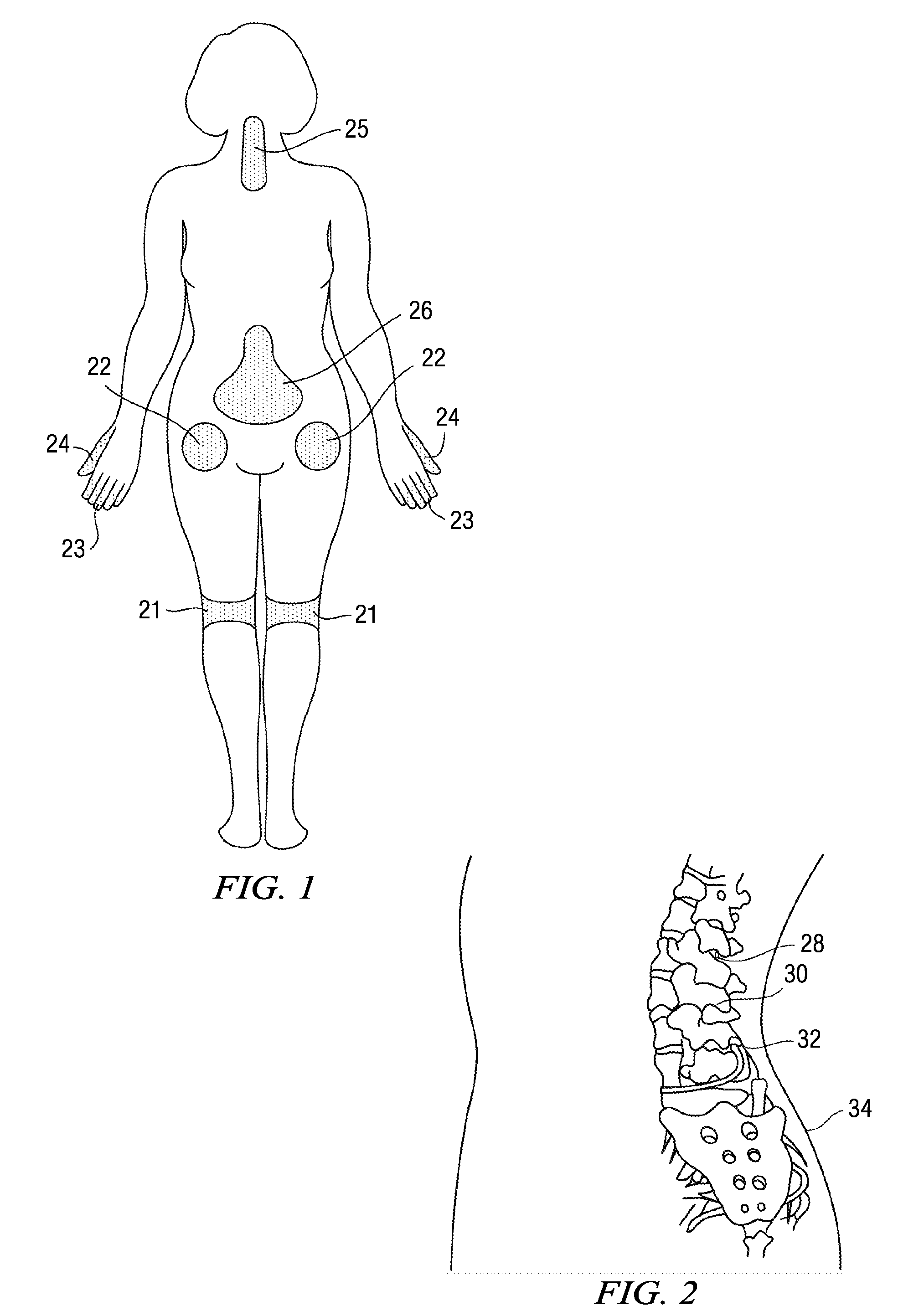 Methods and compositions for treating post-operative pain comprising clonidine
