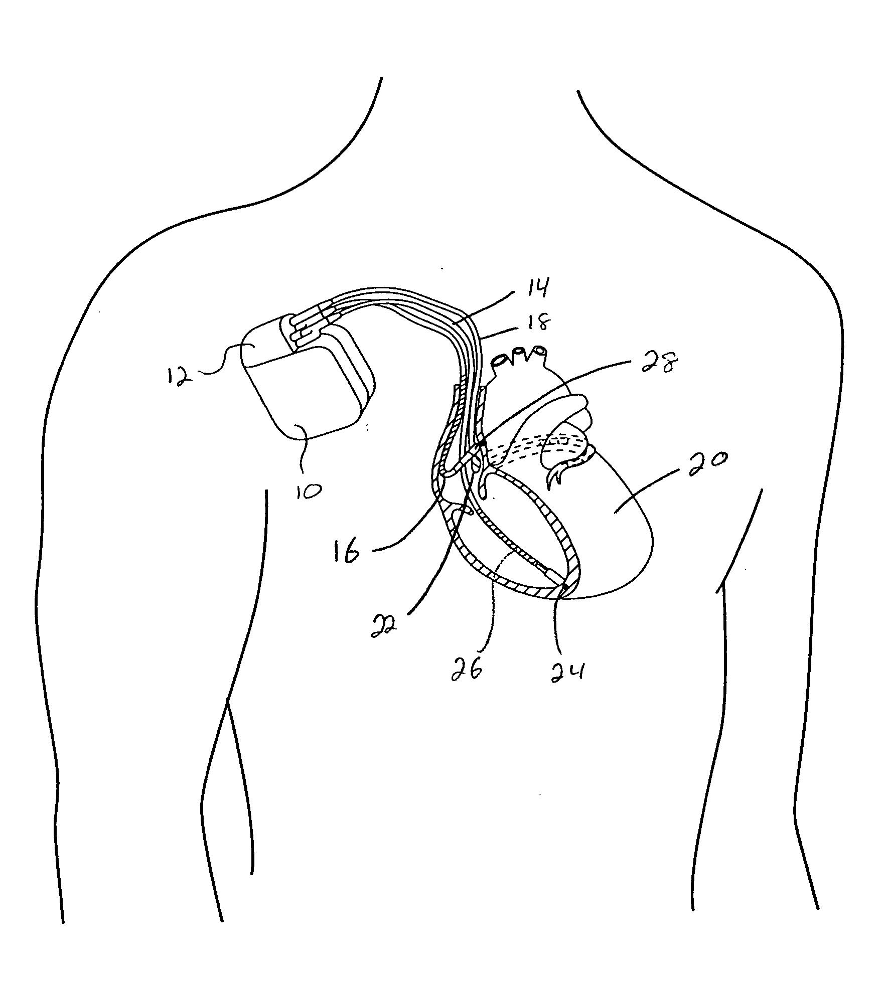 Trans-septal pressure sensor