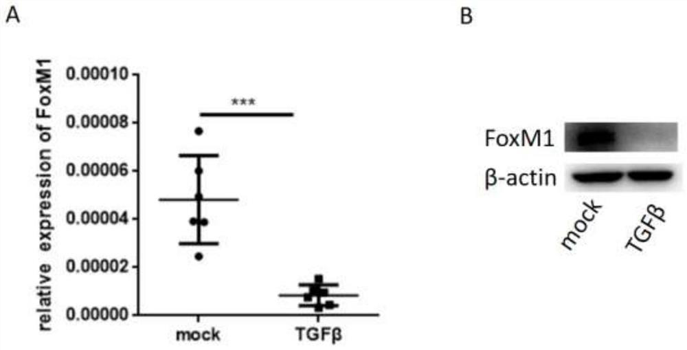 Application of FoxM1 in diagnosis and treatment of intrauterine adhesion diseases