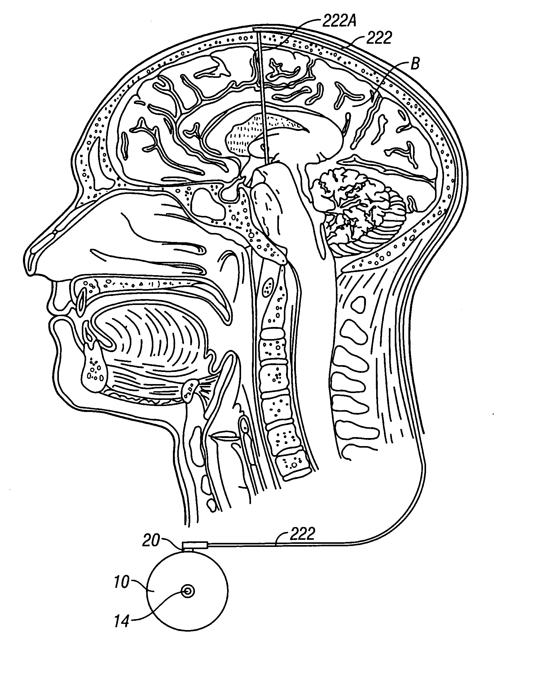 System and method of treating stuttering by neuromodulation