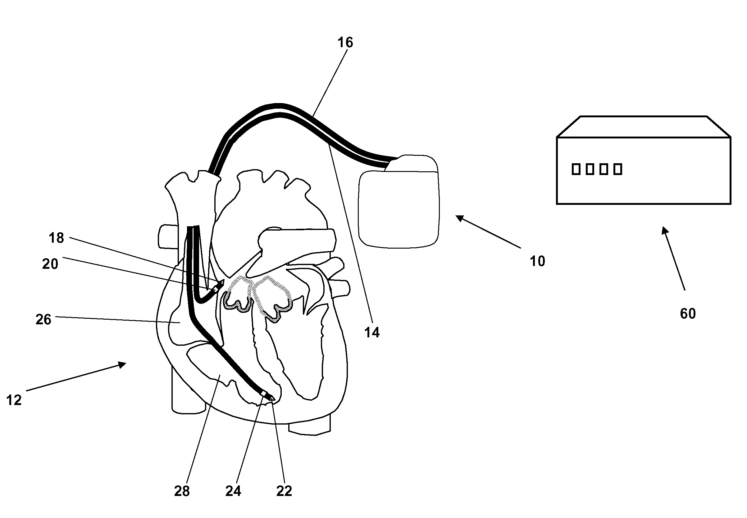 Heart monitoring system and method