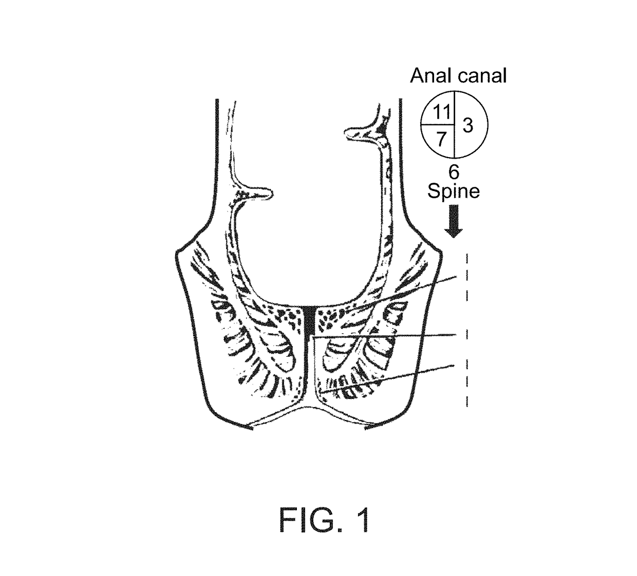 Device for protecting hemorrhoids