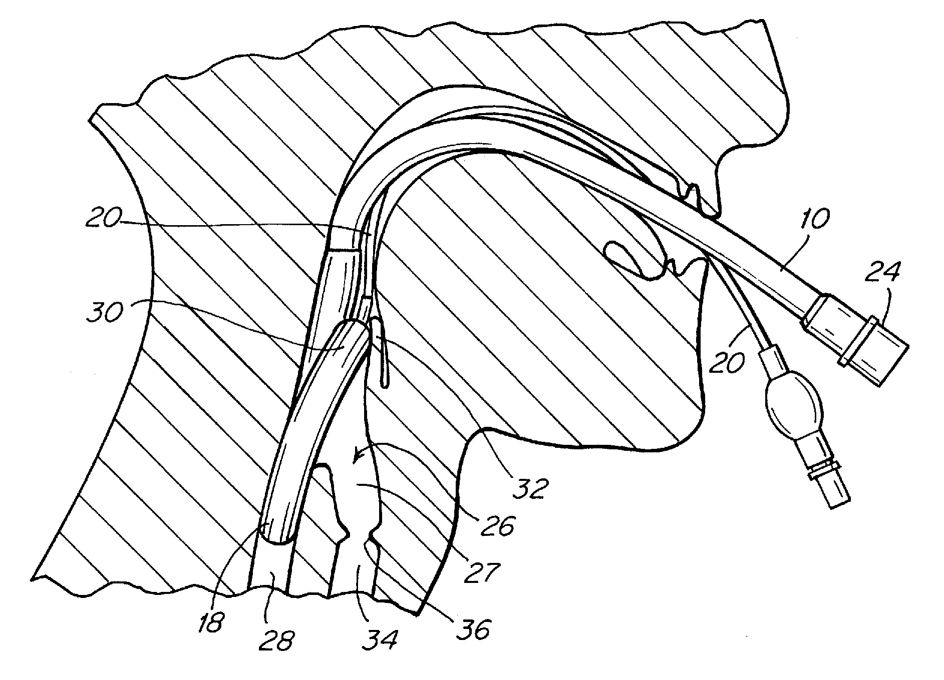 Laryngeal mask airway placement system and method