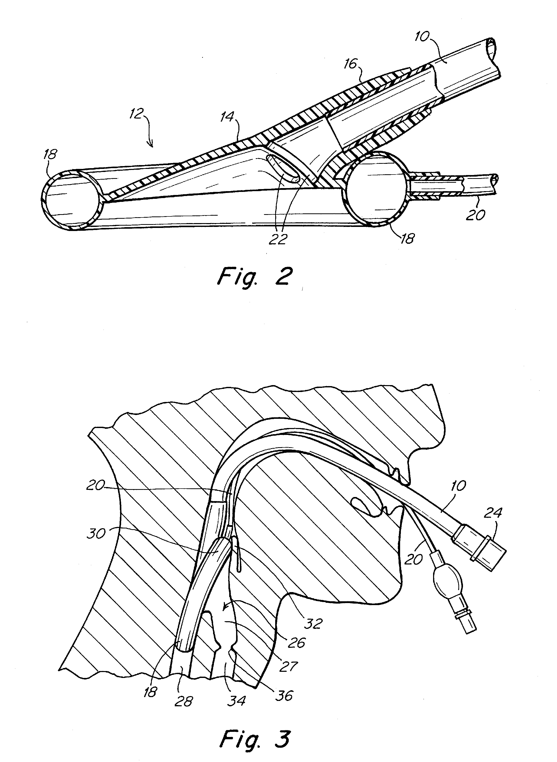 Laryngeal mask airway placement system and method