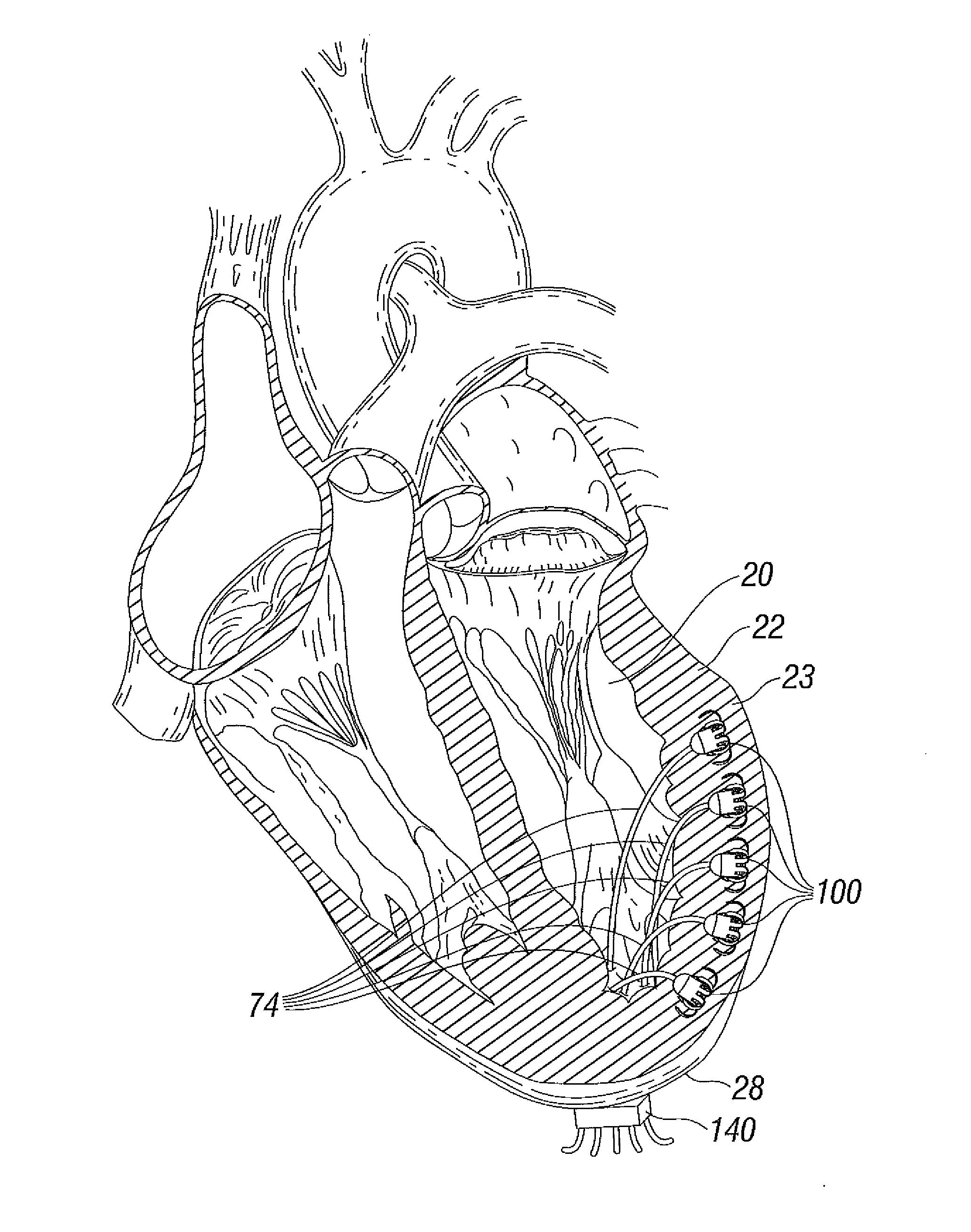 Suture and method for repairing a heart