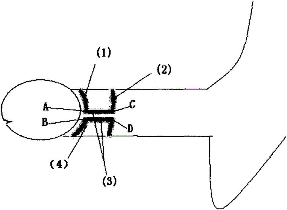 Double-ring prepuce recovering resisting device