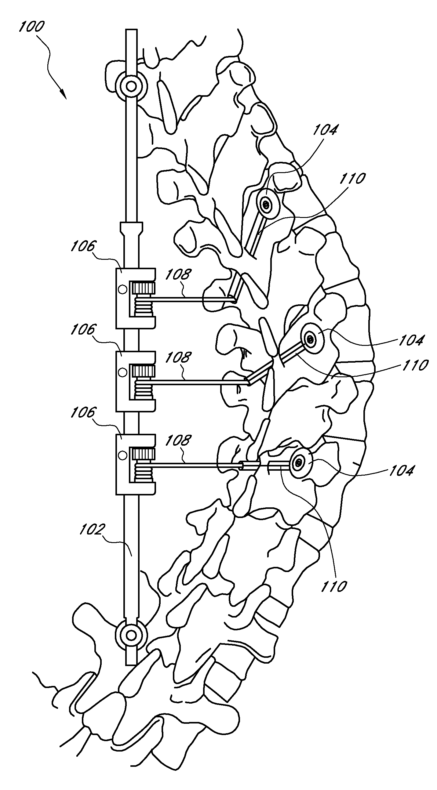 Medical device and method to correct deformity