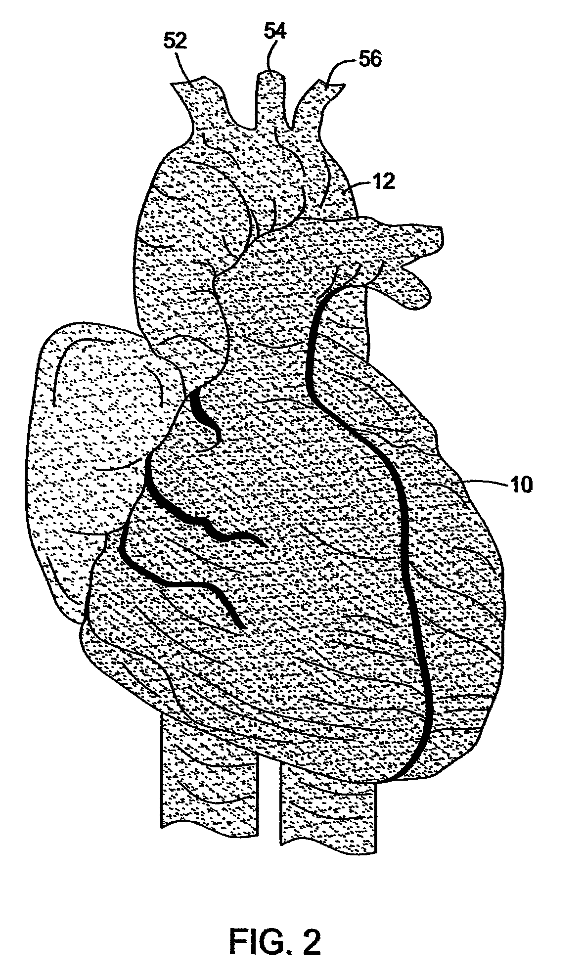 Methods and apparatus for treatment of thoracic aortic aneurysms
