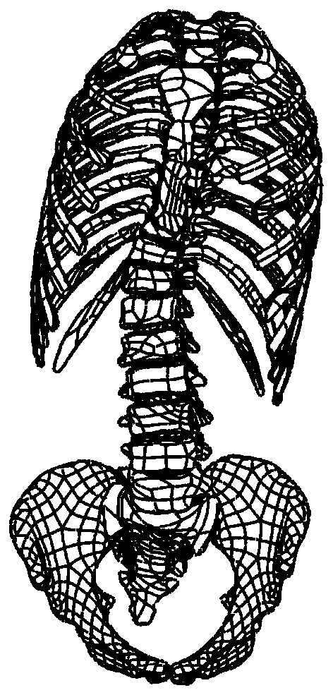 Design method of personalized 3D printing scoliosis orthosis