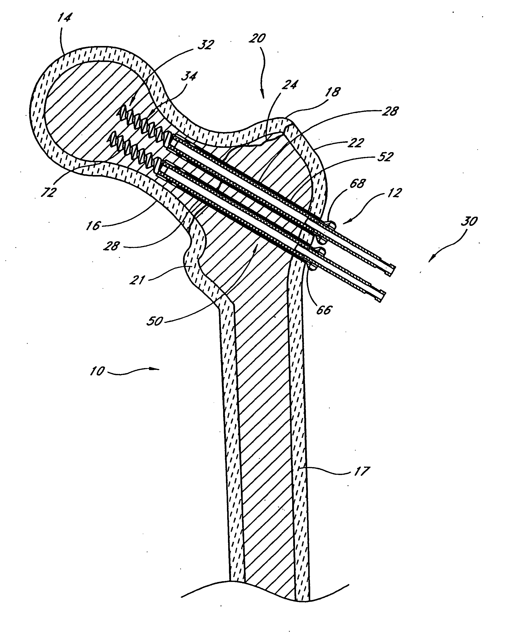 Method and apparatus for bone fixation with secondary compression