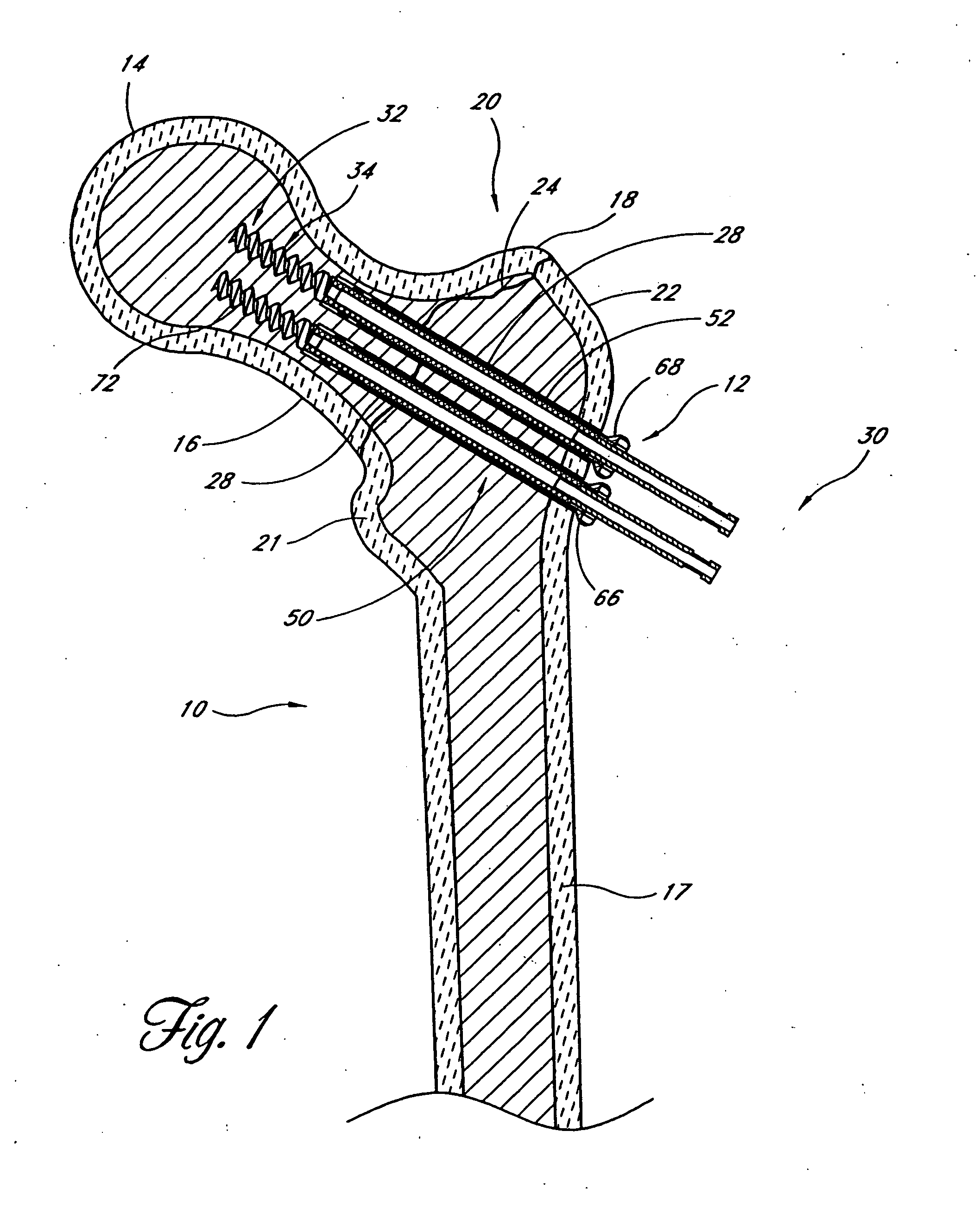 Method and apparatus for bone fixation with secondary compression