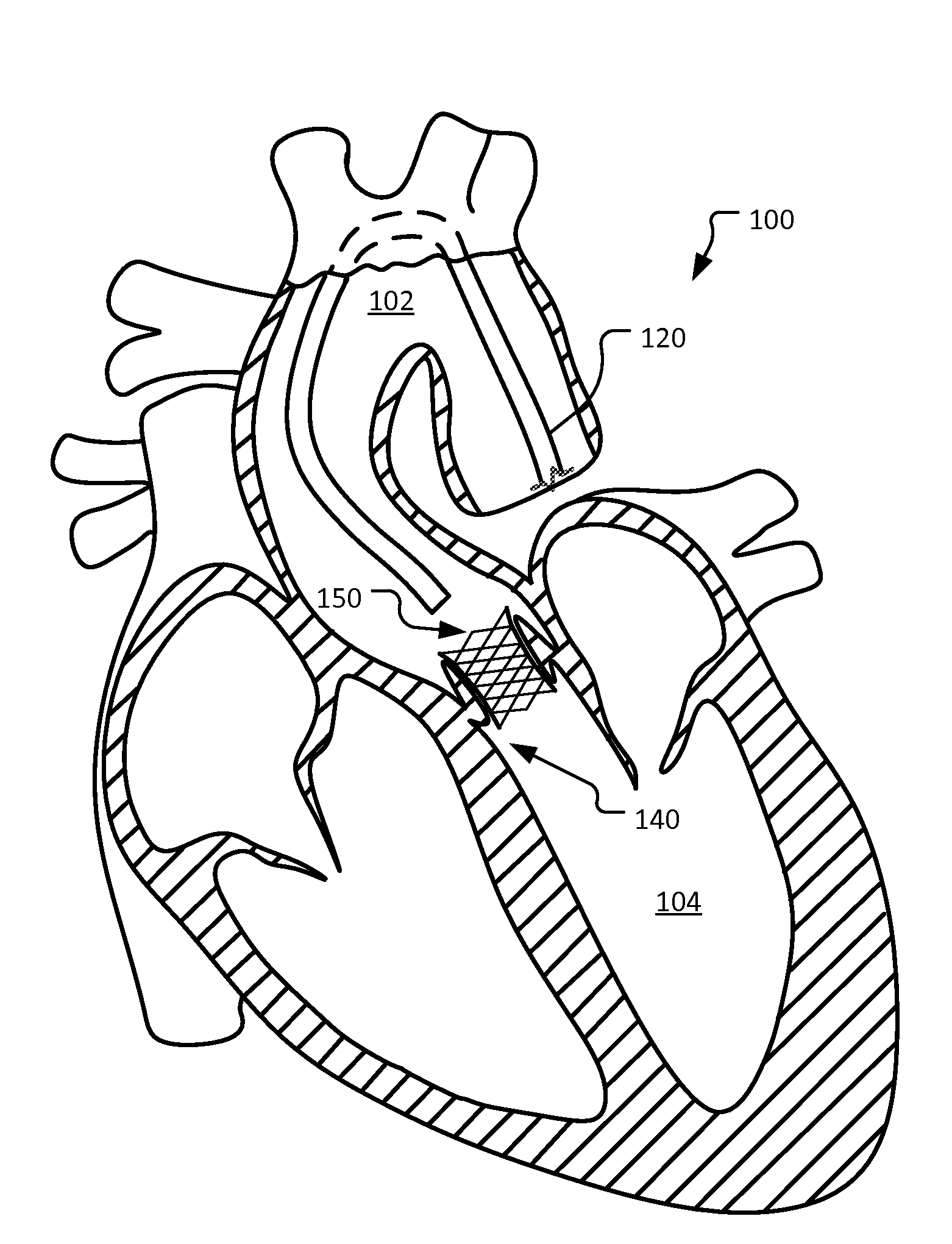 Self-assembling percutaneously implantable heart valve