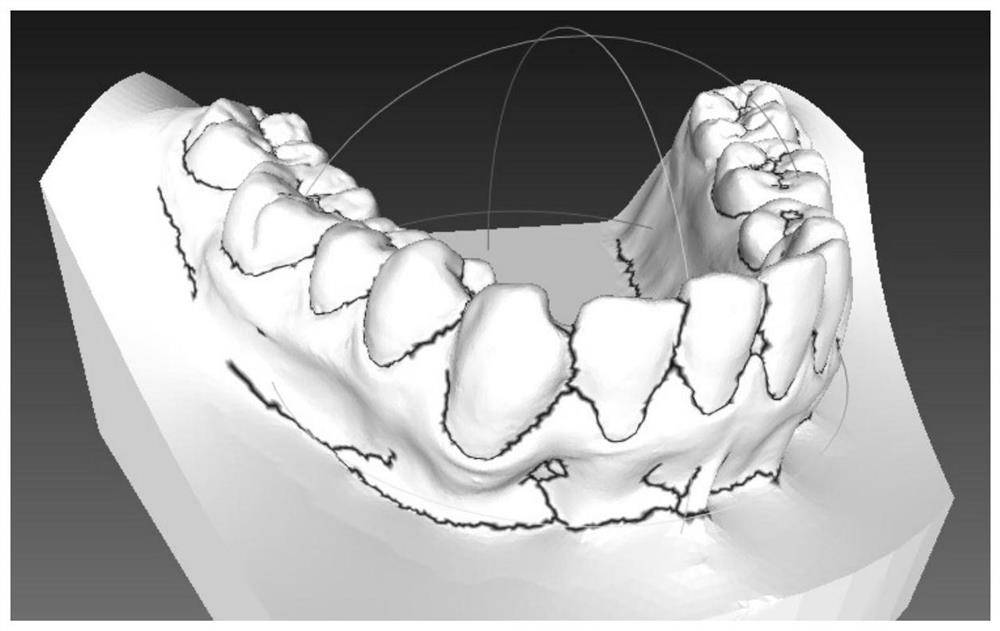 An Automatic Segmentation Method of Three-dimensional Teeth Mesh Model