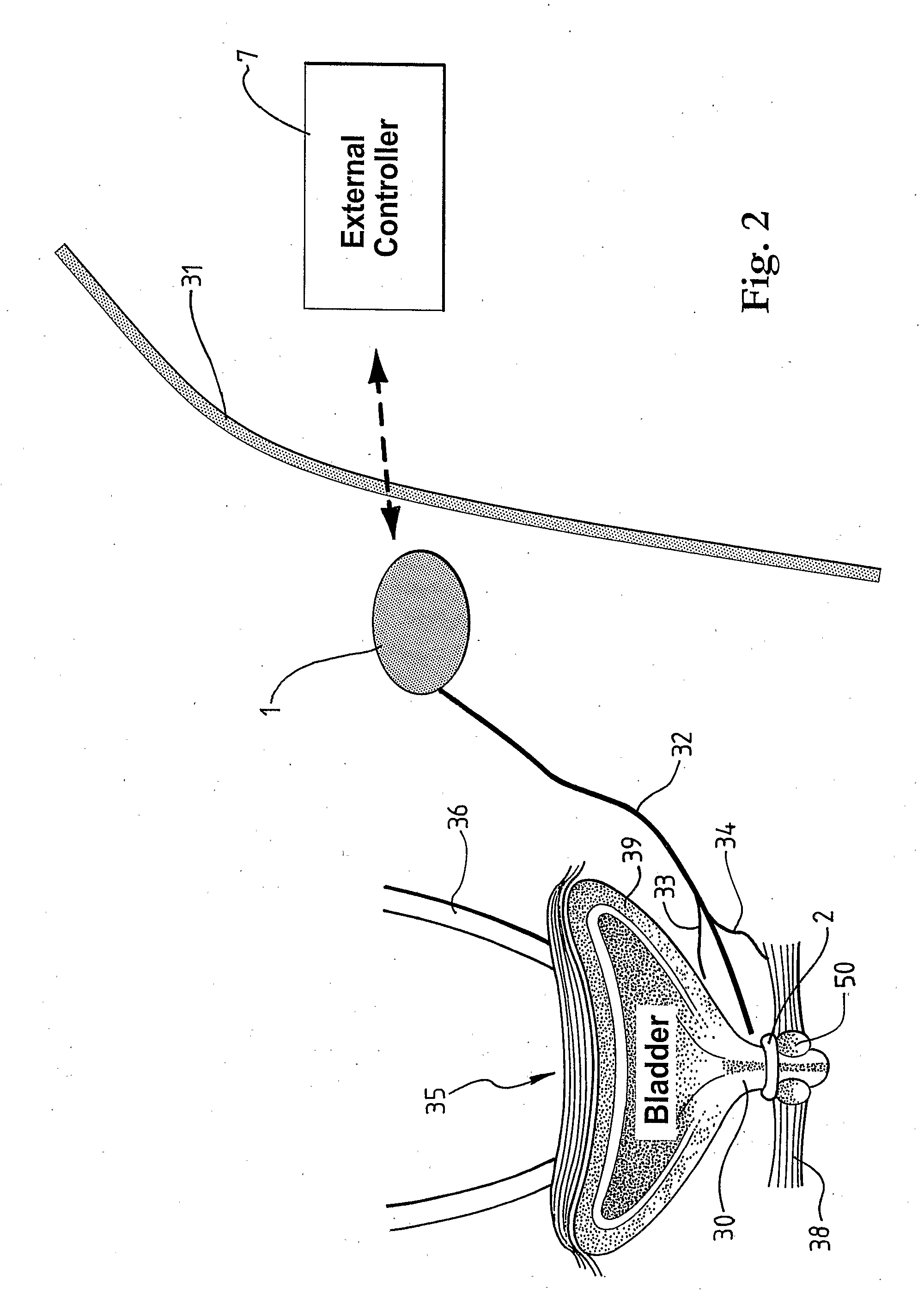 Method and Apparatus for Treating Incontinence