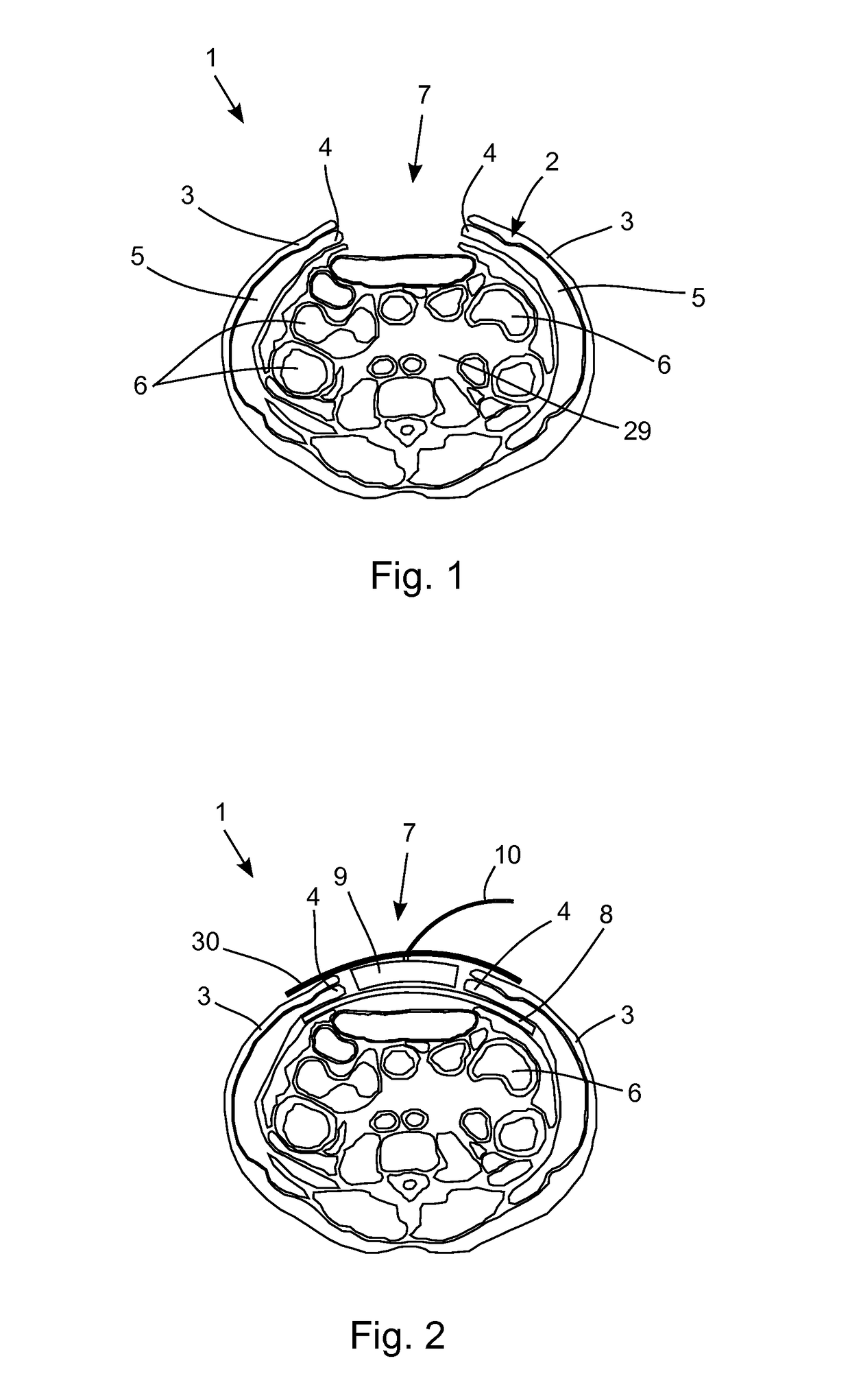 Device for reducing the retraction of a fascia or a soft tissue mantle in an open soft tissue defect