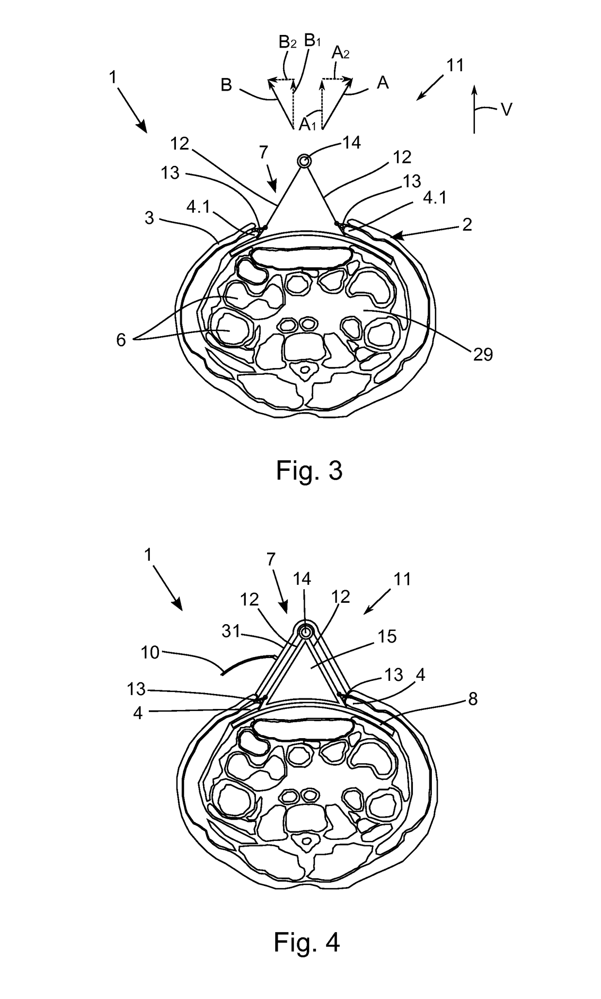 Device for reducing the retraction of a fascia or a soft tissue mantle in an open soft tissue defect